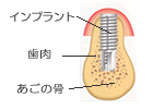 一次手術について