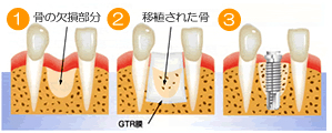 欠損治療について